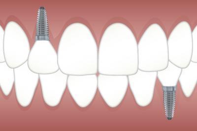 nettoyage implant dentaire lille Wazemmes 59